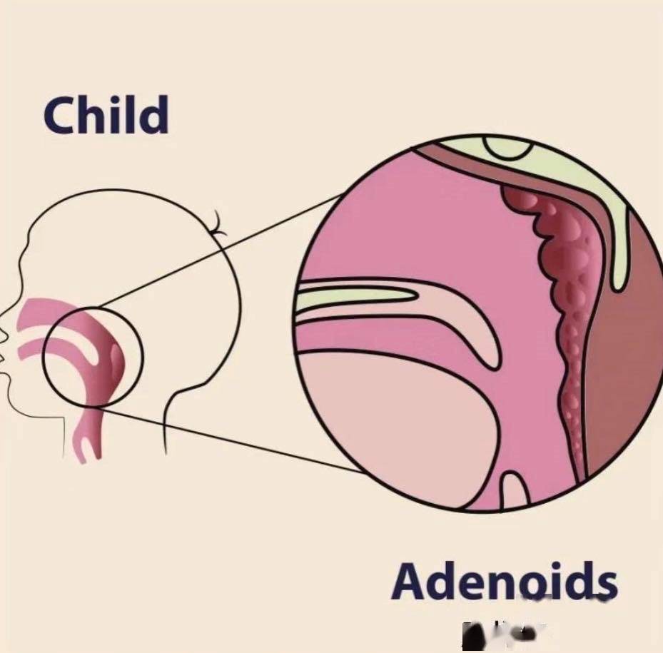 腺样体手术步骤图解图片