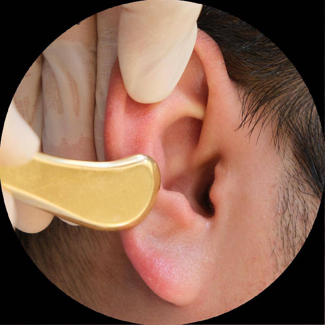 耳穴刮痧法6耳穴放血法5耳穴线香灸法4耳穴灸法3耳穴贴压法2耳穴按摩