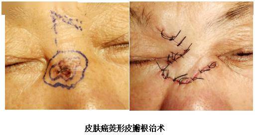 小南便民我院皮肤科开设色素痣和皮肤体表肿物专家专病门诊