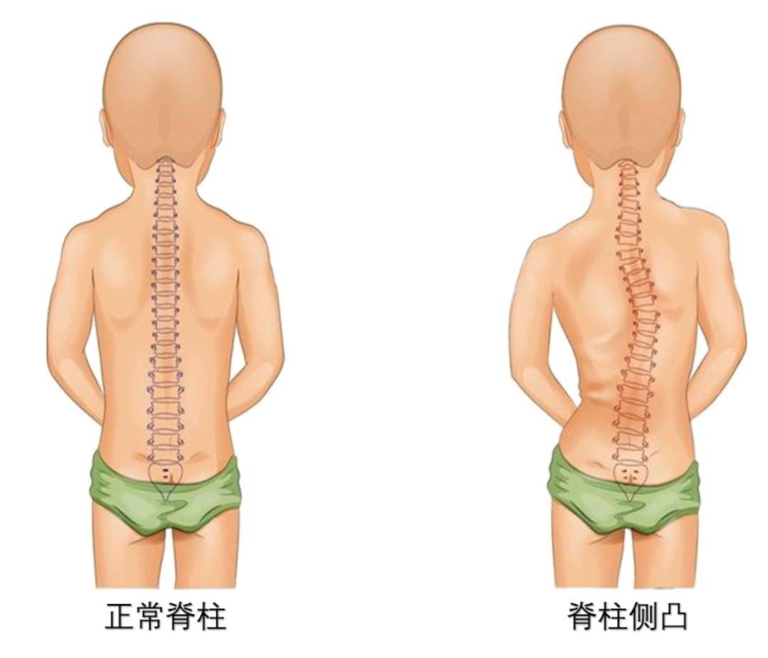 颈椎侧凸图片