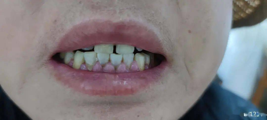 高血压女性反复牙龈肿痛一年余,典型表现,您秒杀了吗?