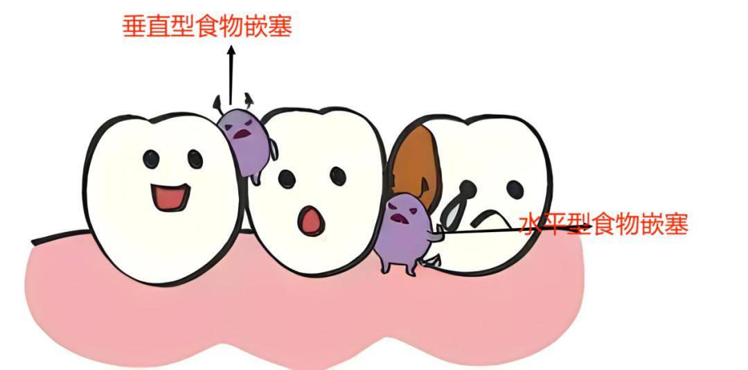 1.垂直型食物嵌塞:即在咀嚼