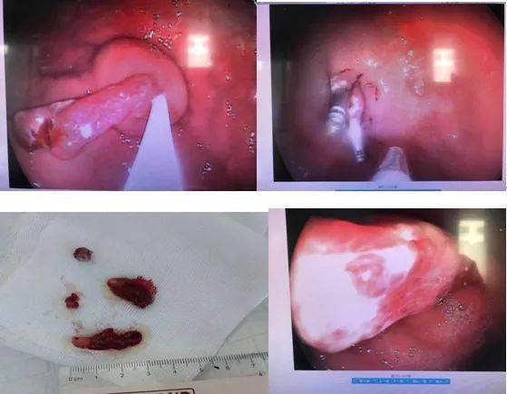 精技术齐医附属二院消化内科成功开展内镜下巨大胃息肉切除术emr