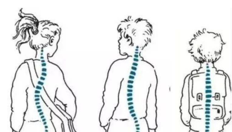 的特发性脊柱侧弯的病因主要有:遗传因素,激素影响,结缔组织发育异常