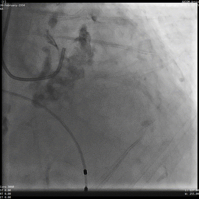 5m/s,垮瓣平均压差8mmhg,微量瓣周漏.
