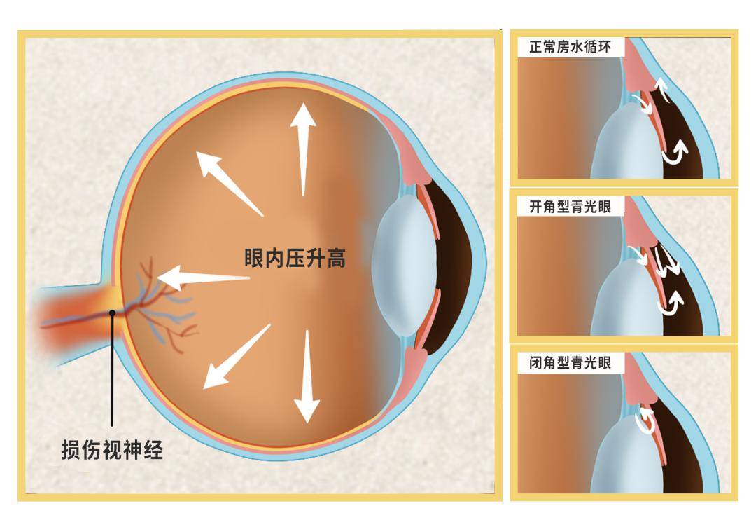 患者由于其眼轴的拉伸增长,导致眼球的正常解剖被改变,巩膜筛板变薄