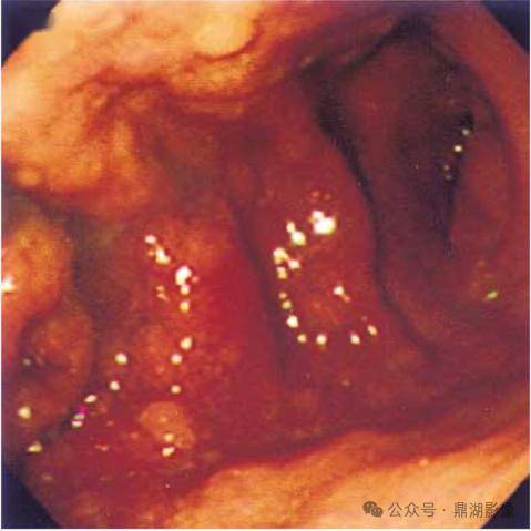 胃镜检查显示,从胃窦到胃体前侧溃疡,其间有充血的胃粘膜(下图3)