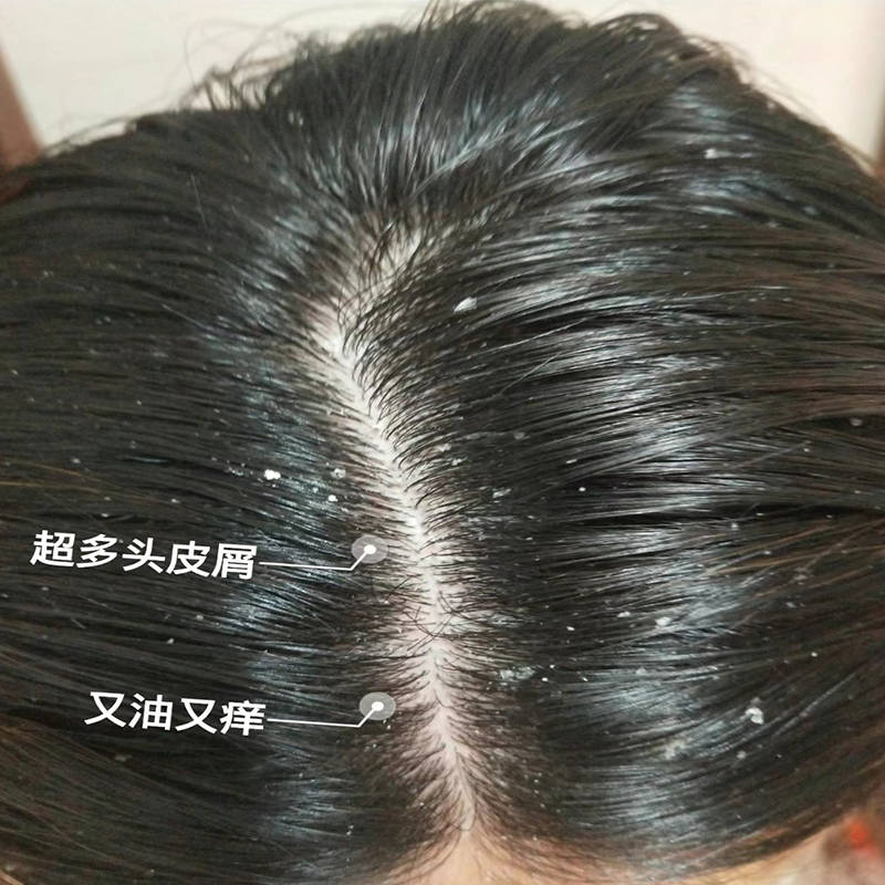 清爽去屑止痒洗发水,是一款为你的头皮问题提供全面解决方案的洗发水