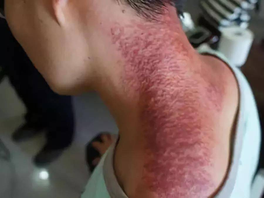 采用膀胱经拔火罐,刮痧,推拿都可以.900_676