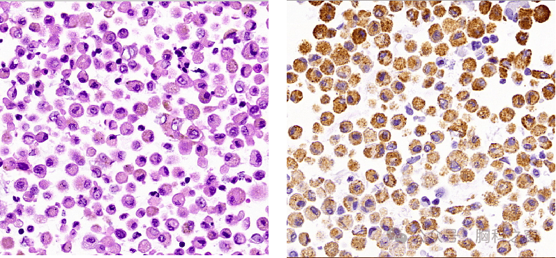 肺泡灌洗液免疫组化:cd68( ),cd1a(少量 ),ck(ae1/ae3)(散在 ),s-100