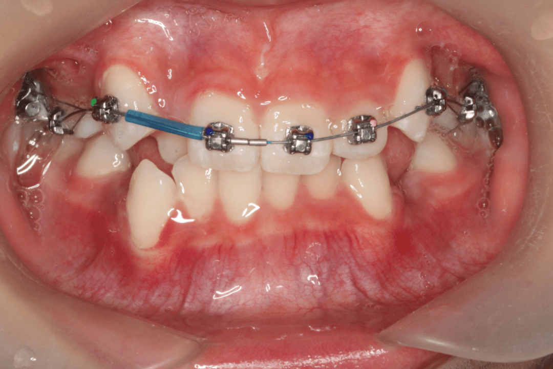 口臭洁牙老年口腔中医口腔门诊即将开诊雁江区人民医院呵护您的牙齿