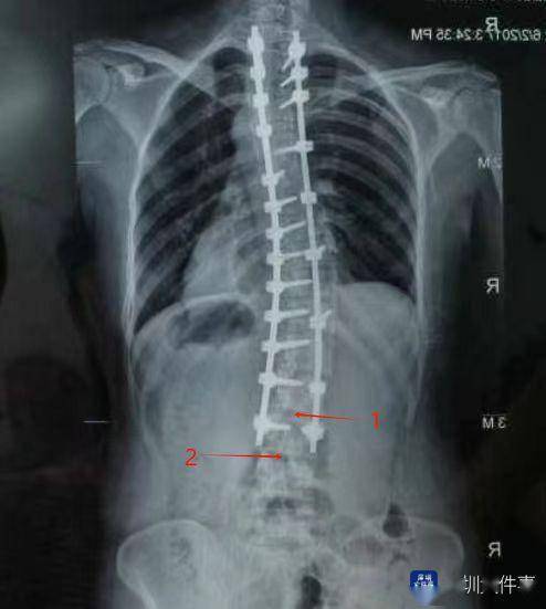 深圳女子严重脊柱侧弯,矫正手术七年后生娃,麻醉医生这样做