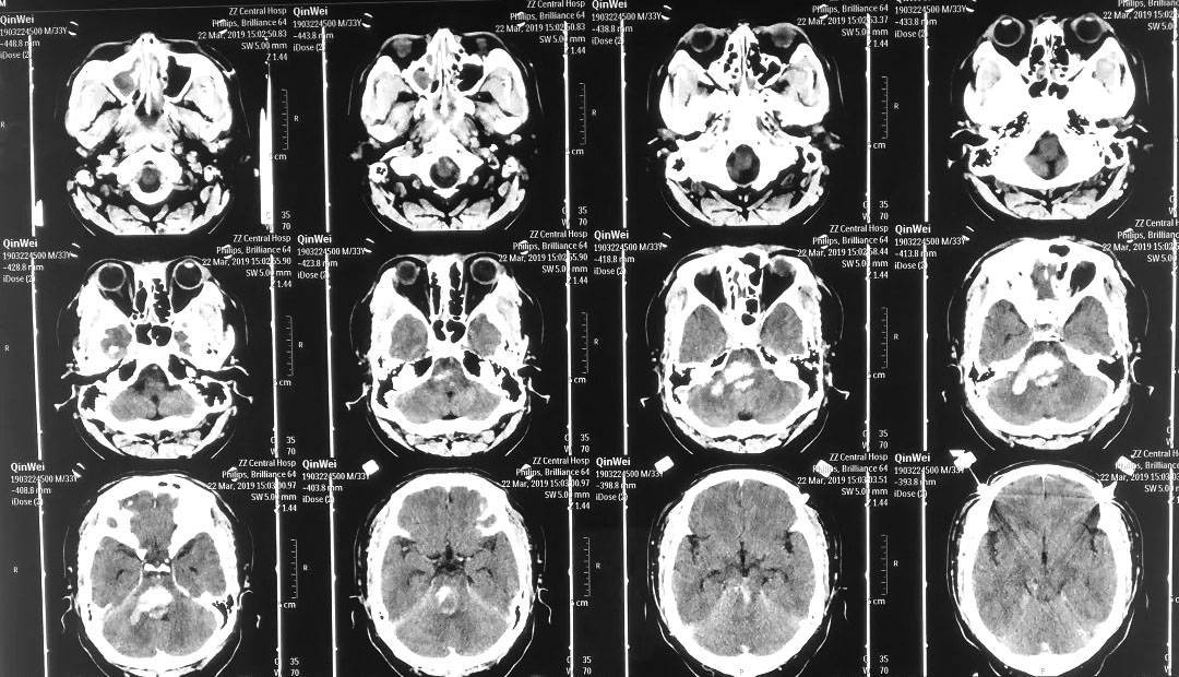 脑干出血的ct片子图片图片