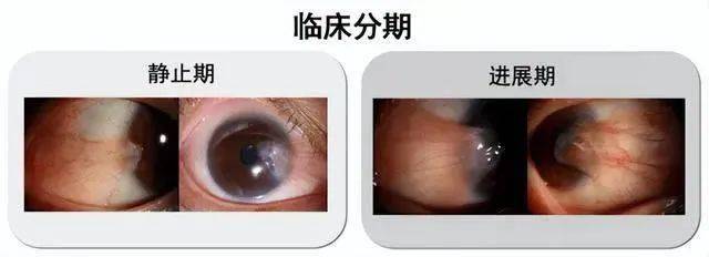 当心长在眼睛里的肉肉——翼状胬肉_角膜_眼镜_症状