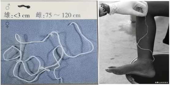 被忽视的热带病之麦地那龙线虫病