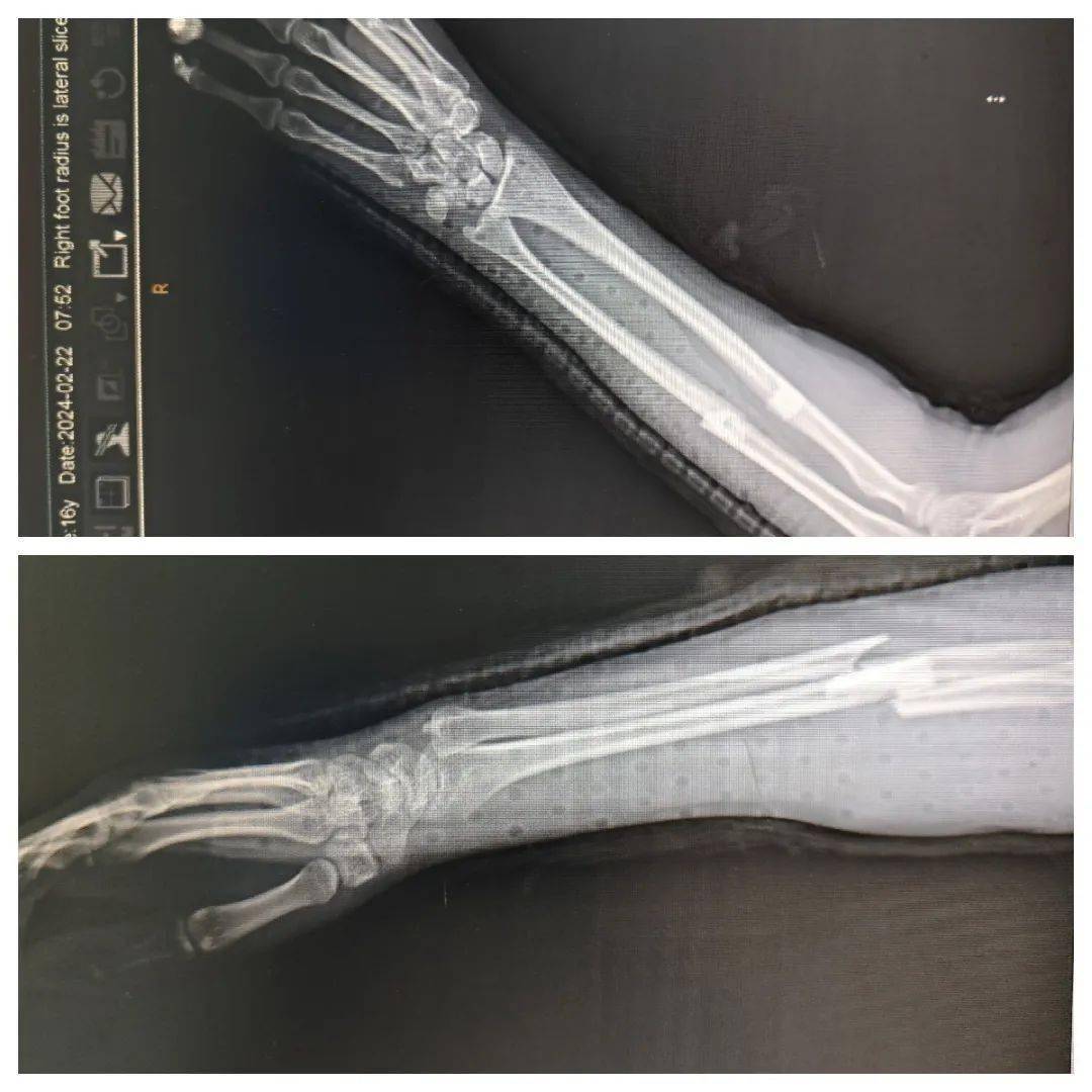 16岁少女前臂双骨折术后3天即重返校园
