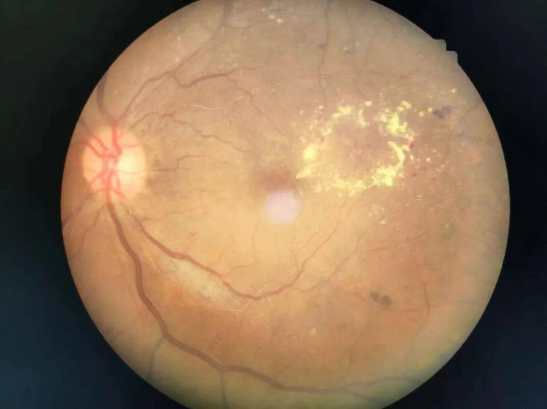 迎难而上吓人得了糖尿病会摘除眼球