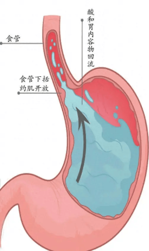 酸溜溜的挑战！揭秘胃食管反流病的用药秘籍_药物_症状_治疗