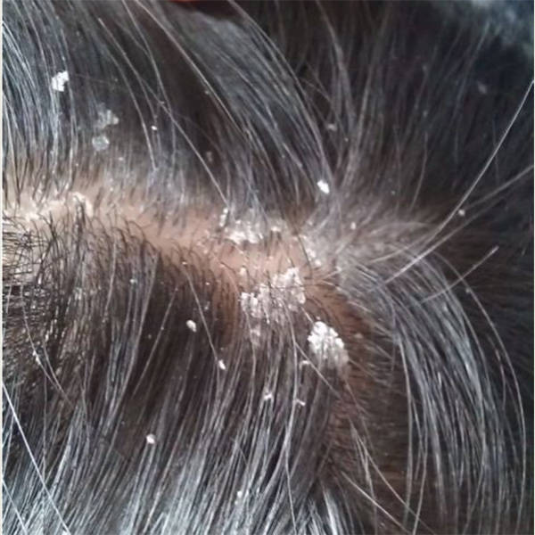 头皮问题产生原因如下:大块头屑,头痒,毛囊炎,小红疹和脂溢性皮炎是