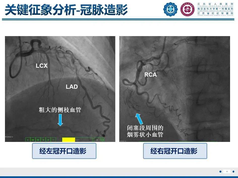 冠脉慢性完全闭塞性病变不通也痛