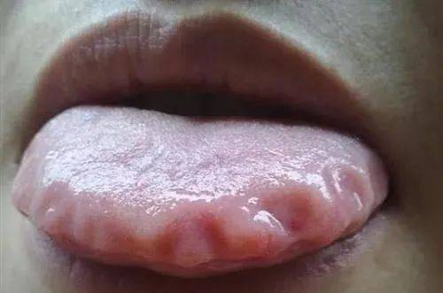 舌头中间有裂纹,或者边缘有齿痕等,是『疾病征兆』?还