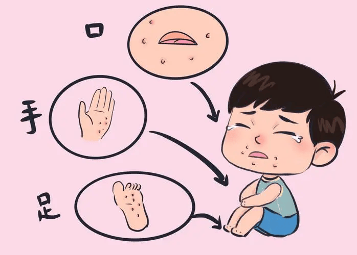 手足口病高发季将至中招了怎么办