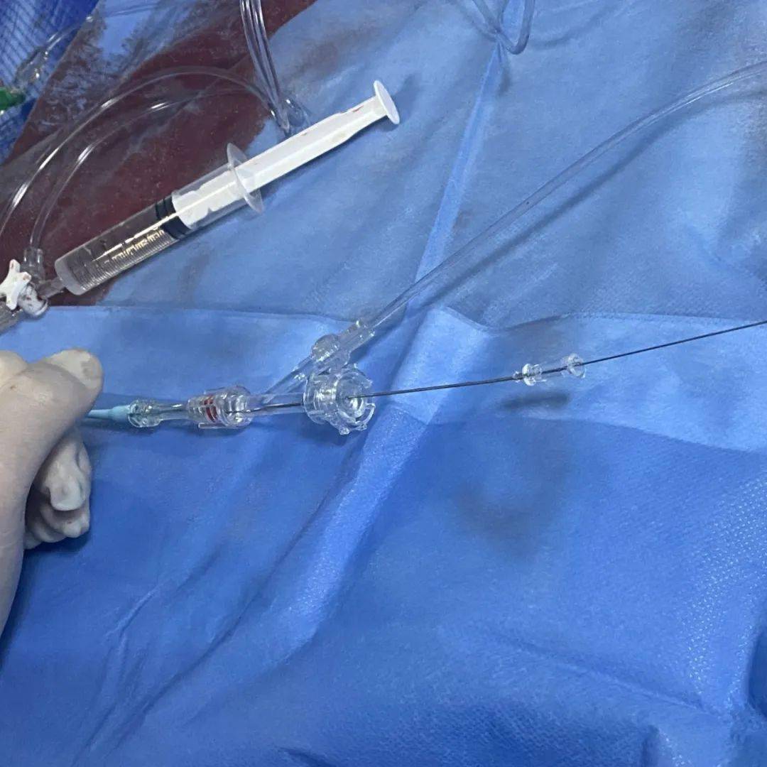 因通路过于迂曲,密网支架在推送的过程中阻力很大,通过在支架推送杆处