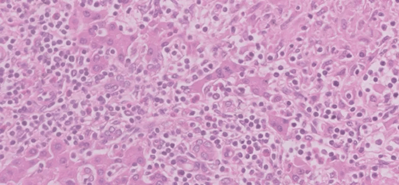 组织学显示非坏死性肉芽肿性病变,由组织细胞,多核巨细胞,淋巴细胞和