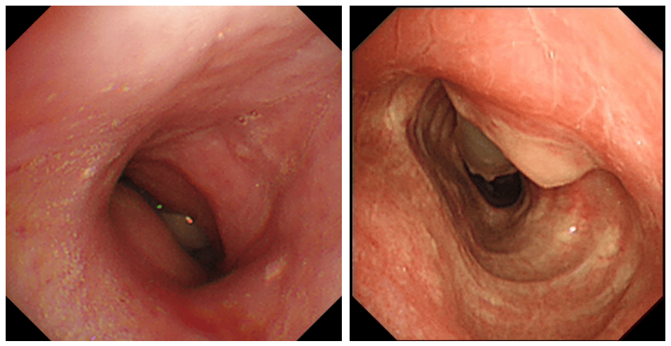 虽然肿瘤已切除,但此时的黄婆婆仍面临着一个大难题:无法脱离气切导管