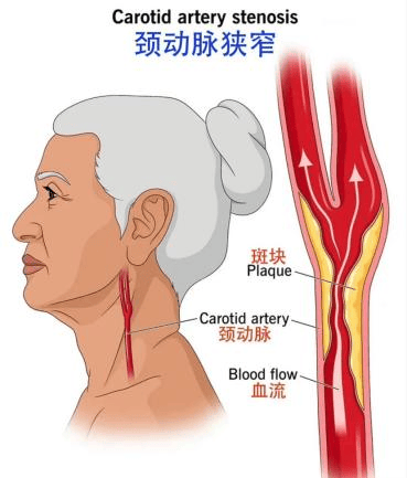 颈动脉的具体位置图片图片