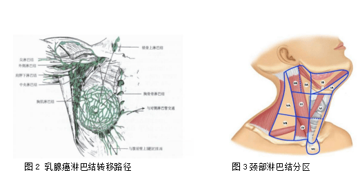 乳腺前哨淋巴结的位置图片