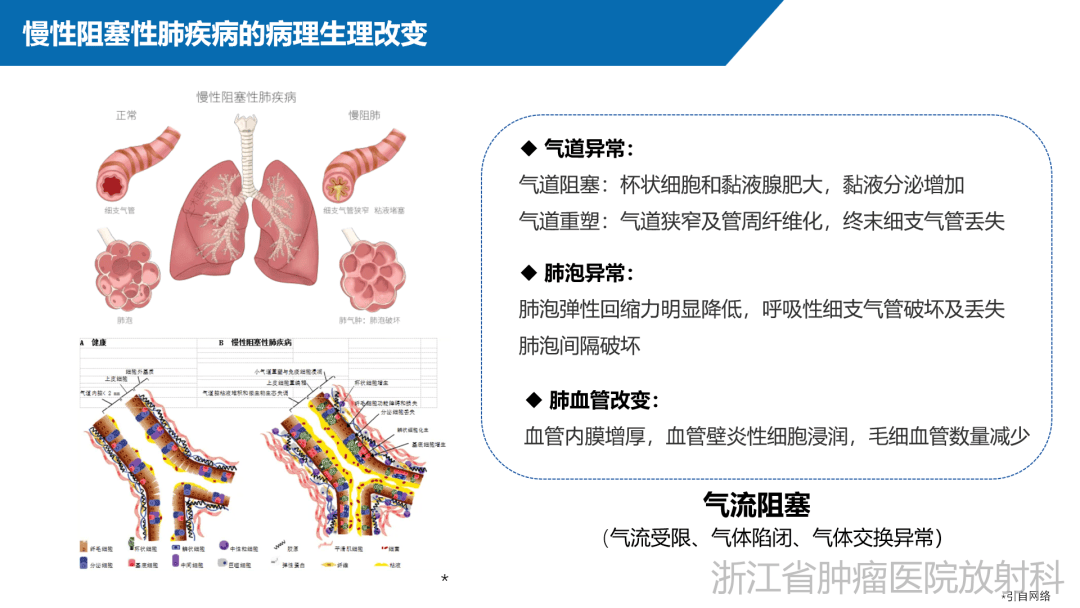 肺气肿的发病机制图片