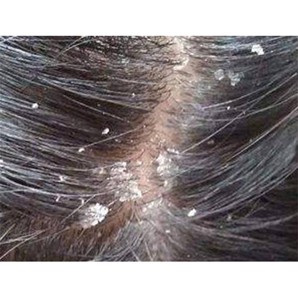 洗发水那个去屑止痒男生控油去屑洗发水排行榜