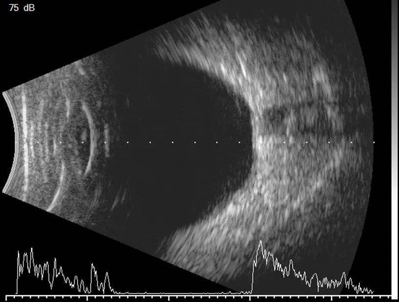 带您了解眼部b超