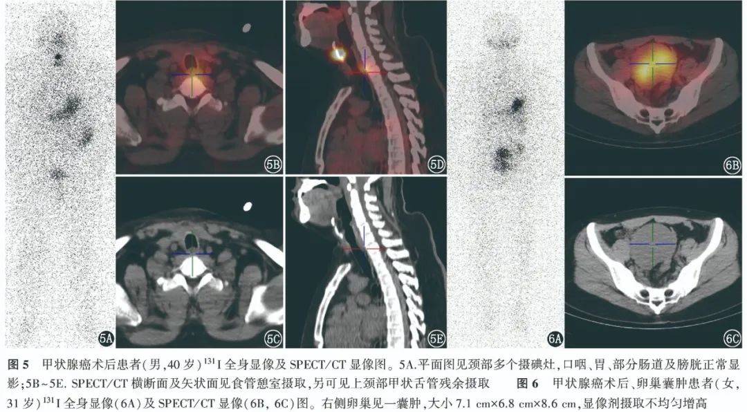 学术131i全身显像的真真假假