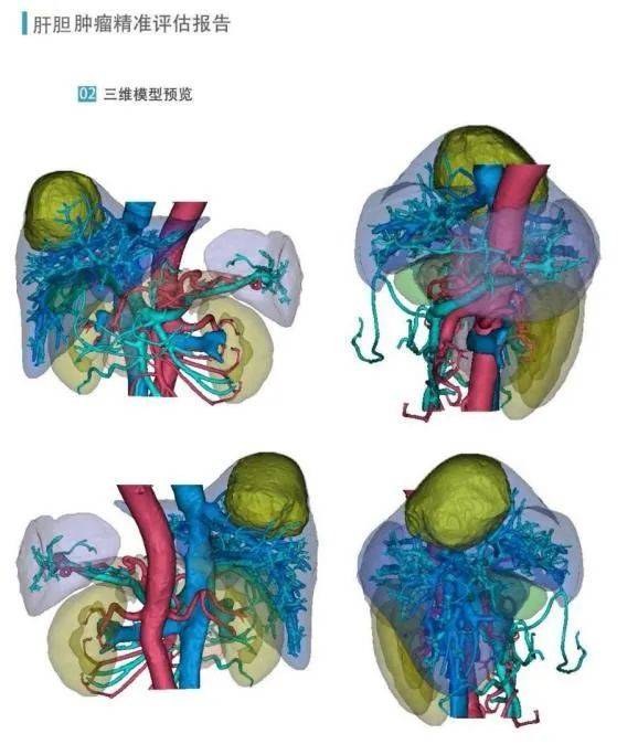 面对患者复杂的s7,s8段肝脏肿瘤病情,我院迅速启动mdt机制,集结肝胆胰