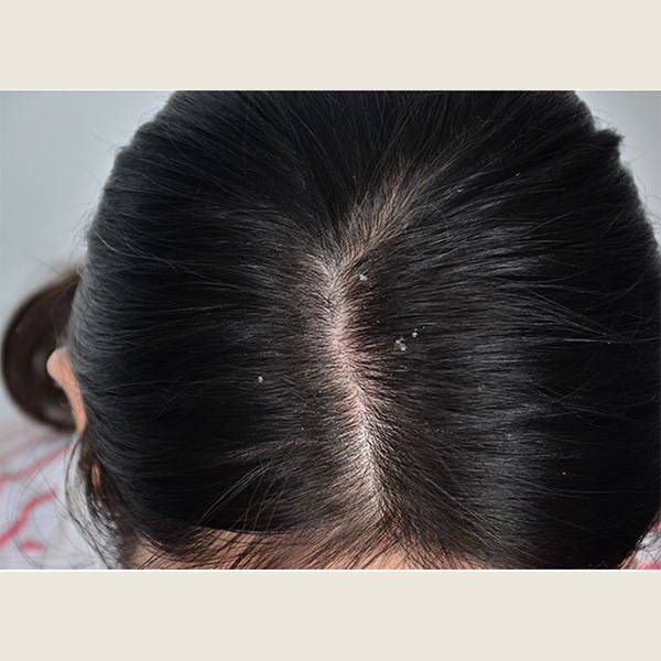 洗发水去屑剂有哪些中国最安全的洗发水