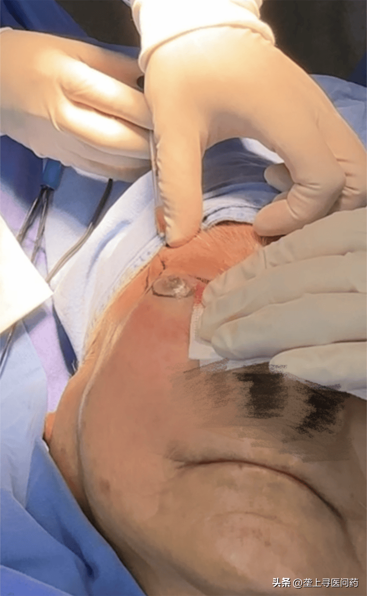 手术_周伟_细胞