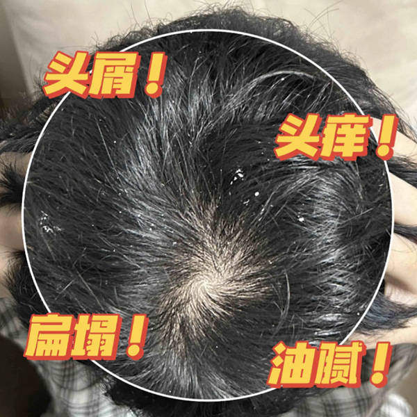 用什么洗发水能止痒控油去屑止痒洗发水推荐