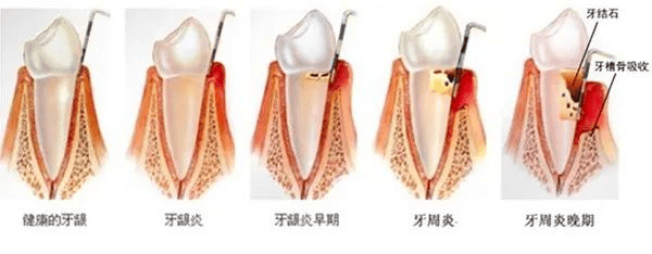 牙疼!牙酸!我的牙到底是咋了?
