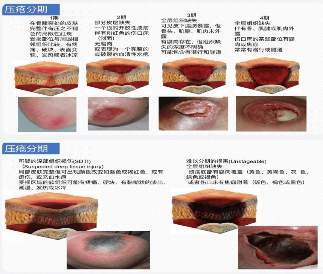 1期压疮图片