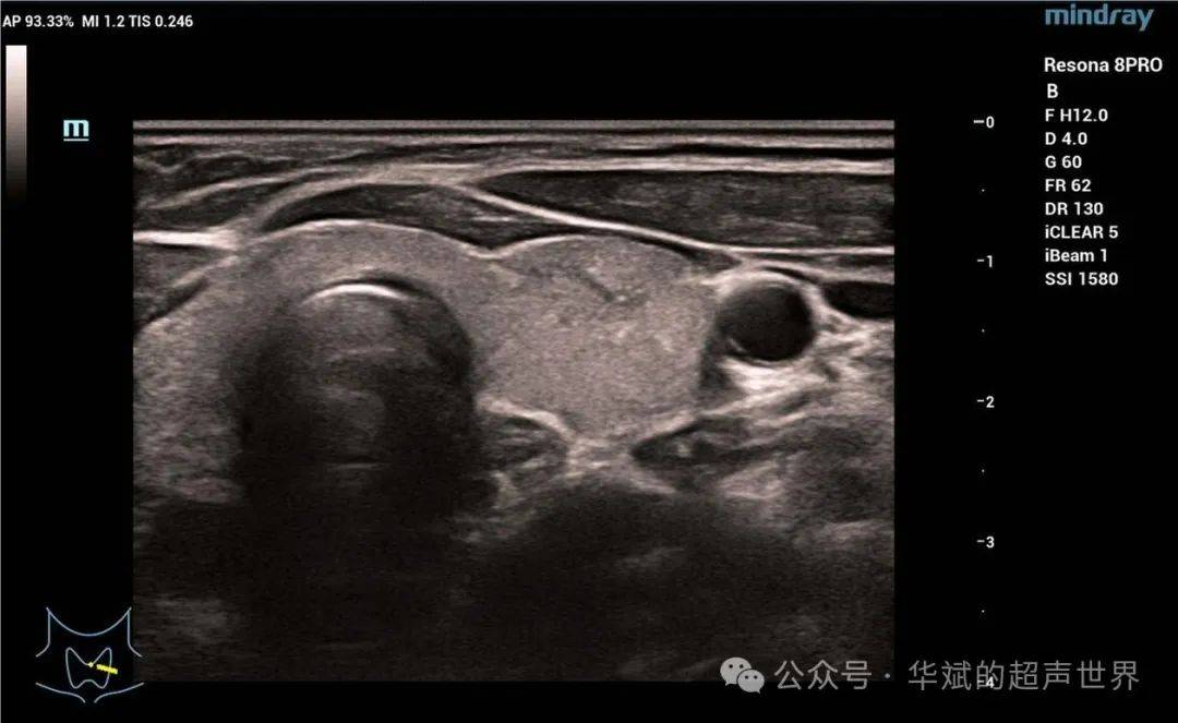 甲状软骨超声图像图片