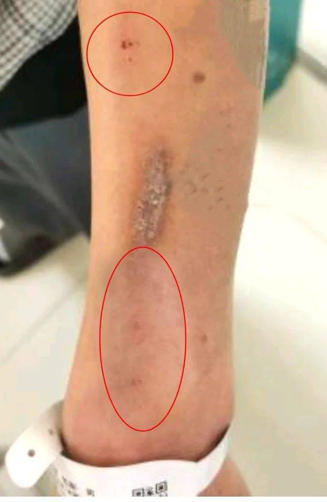 警惕：硫辛酸注射液可能引发的皮肤反应！