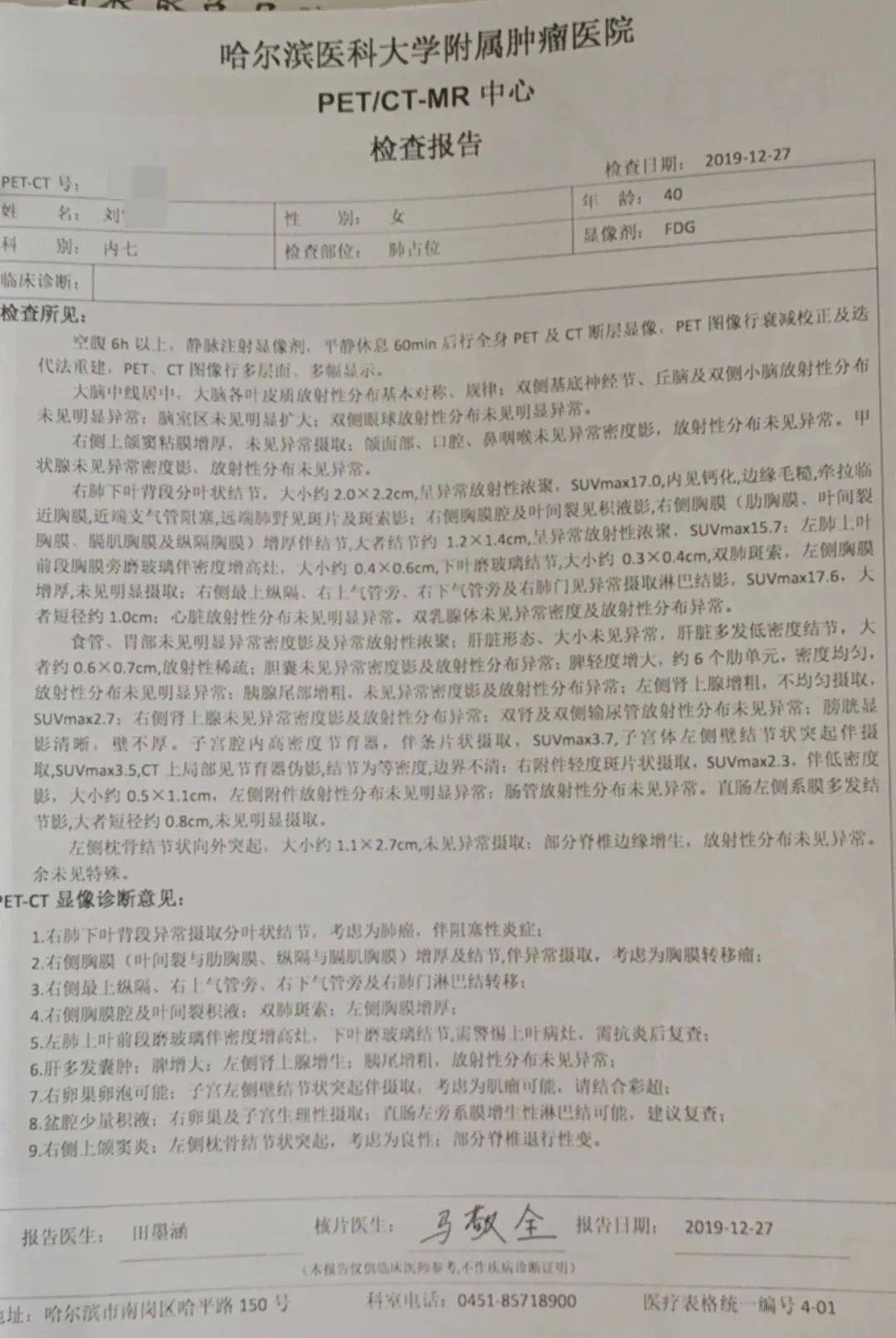 引导下取右肺叶后下半段组织,免疫组化显示浸润恶性肿瘤来源于肺腺癌