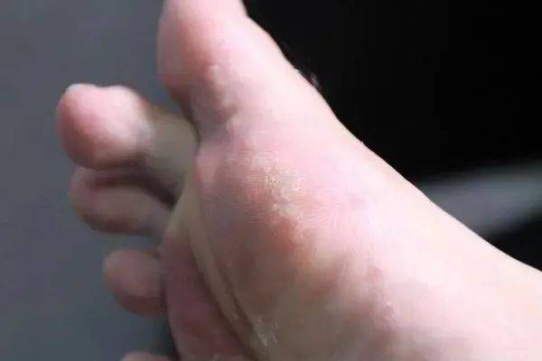 足癣和股癣是由真菌感染而引起的皮肤病,由于真菌喜好温暖和潮湿,因此