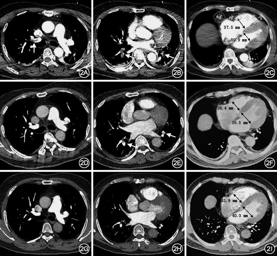 【病例报告】低剂量抗凝成功治疗高危肺栓塞1例