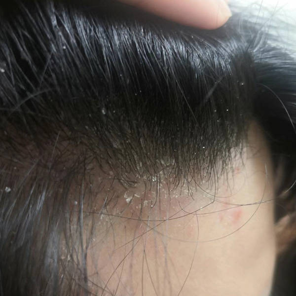 无论你是否困扰于头屑,头痒,毛囊炎,小红疹或脂溢性皮炎,这款洗发水