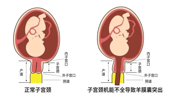 复发性中晚期妊娠流产及早产的原因之一