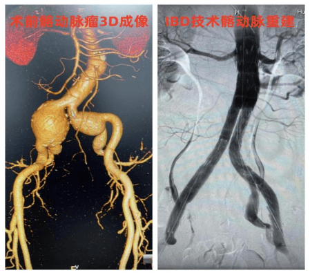 髂总动脉分支图片