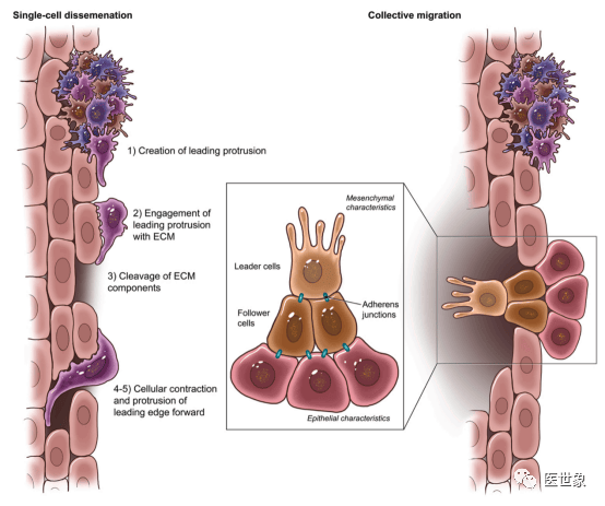癌细胞是如何发生转移的?